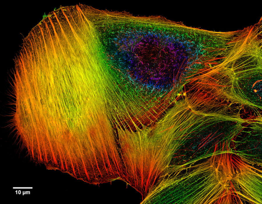 An image of a cancer cell that has been enhanced using deconvolution.