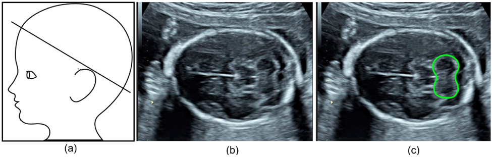 segmentation of cerebellum in fetal ultrasound scan