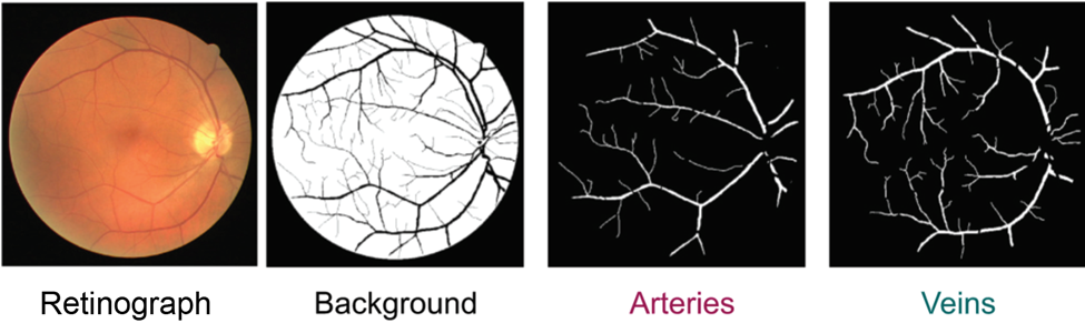 Segmentation of retinal arteries from a retinograph image