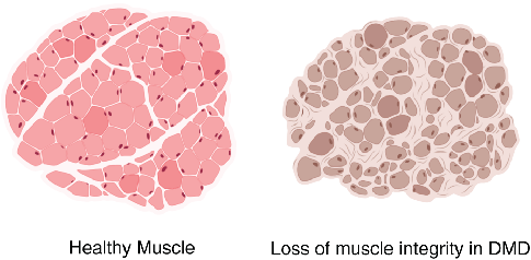 a schematic comparing healthy muscle fibers vs muscle fibers in Duchenne muscular dystrophy
